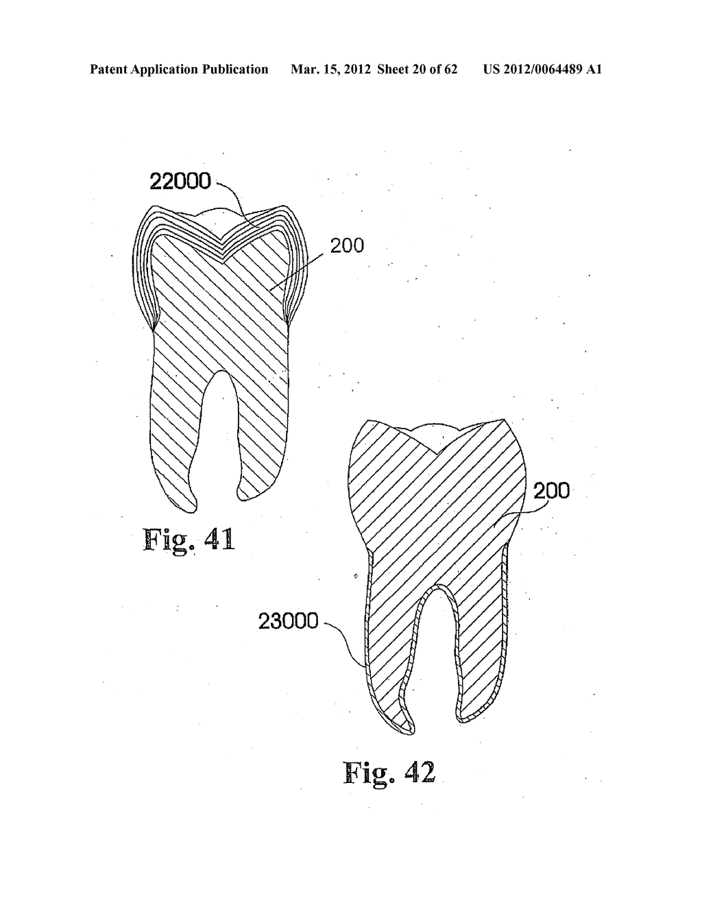 CUSTOMIZED DENTAL PROSTHESIS FOR PERIODONTAL OR OSSEOINTEGRATION AND     RELATED SYSTEMS - diagram, schematic, and image 21