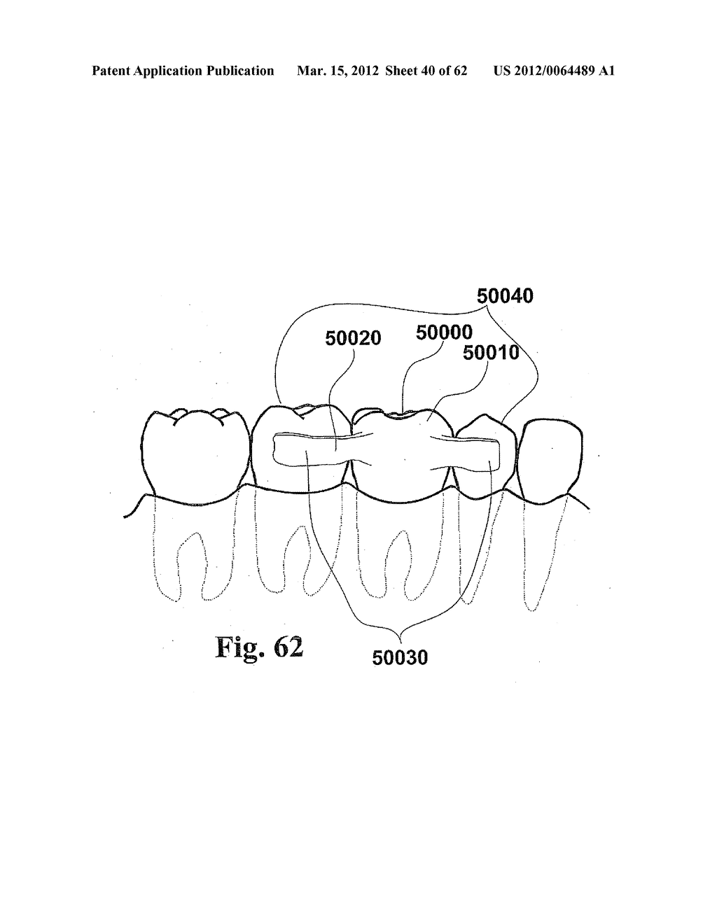 CUSTOMIZED DENTAL PROSTHESIS FOR PERIODONTAL OR OSSEOINTEGRATION AND     RELATED SYSTEMS - diagram, schematic, and image 41