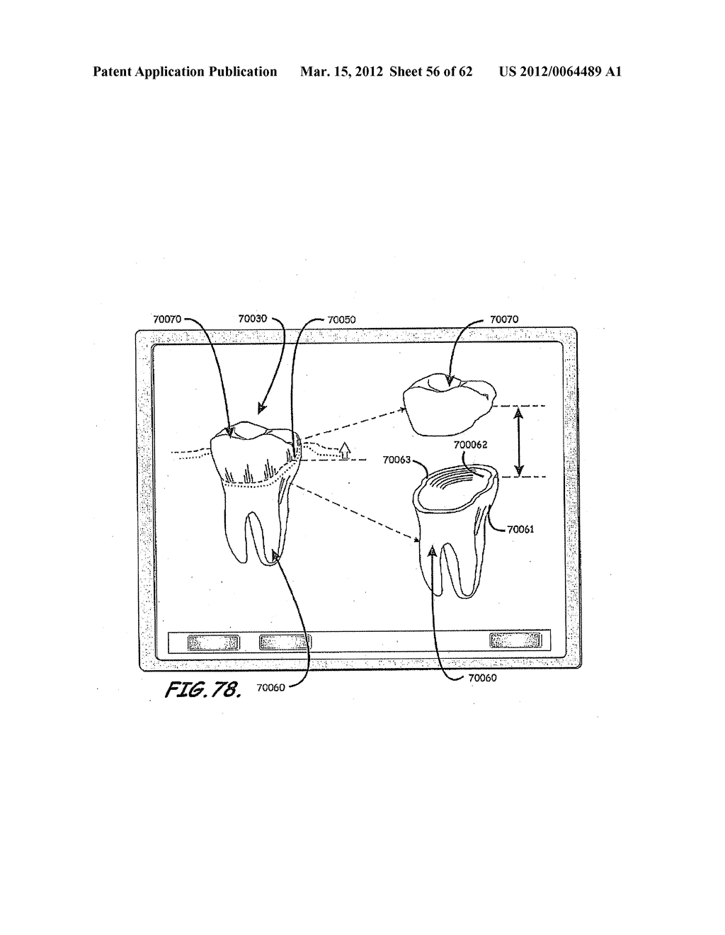 CUSTOMIZED DENTAL PROSTHESIS FOR PERIODONTAL OR OSSEOINTEGRATION AND     RELATED SYSTEMS - diagram, schematic, and image 57