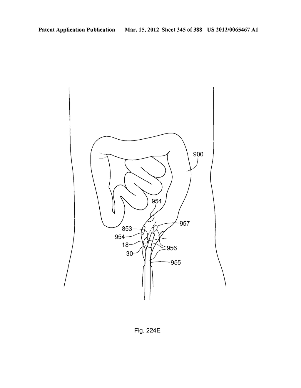 ROBOTIC CATHETER SYSTEM AND METHODS - diagram, schematic, and image 346