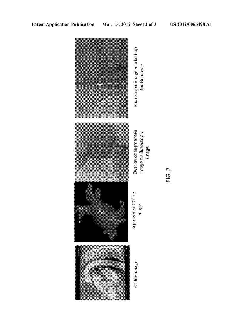 APPARATUS AND METHOD FOR MINIMALLY INVASIVE THERAPY OF MITRAL     REGURGITATION - diagram, schematic, and image 03