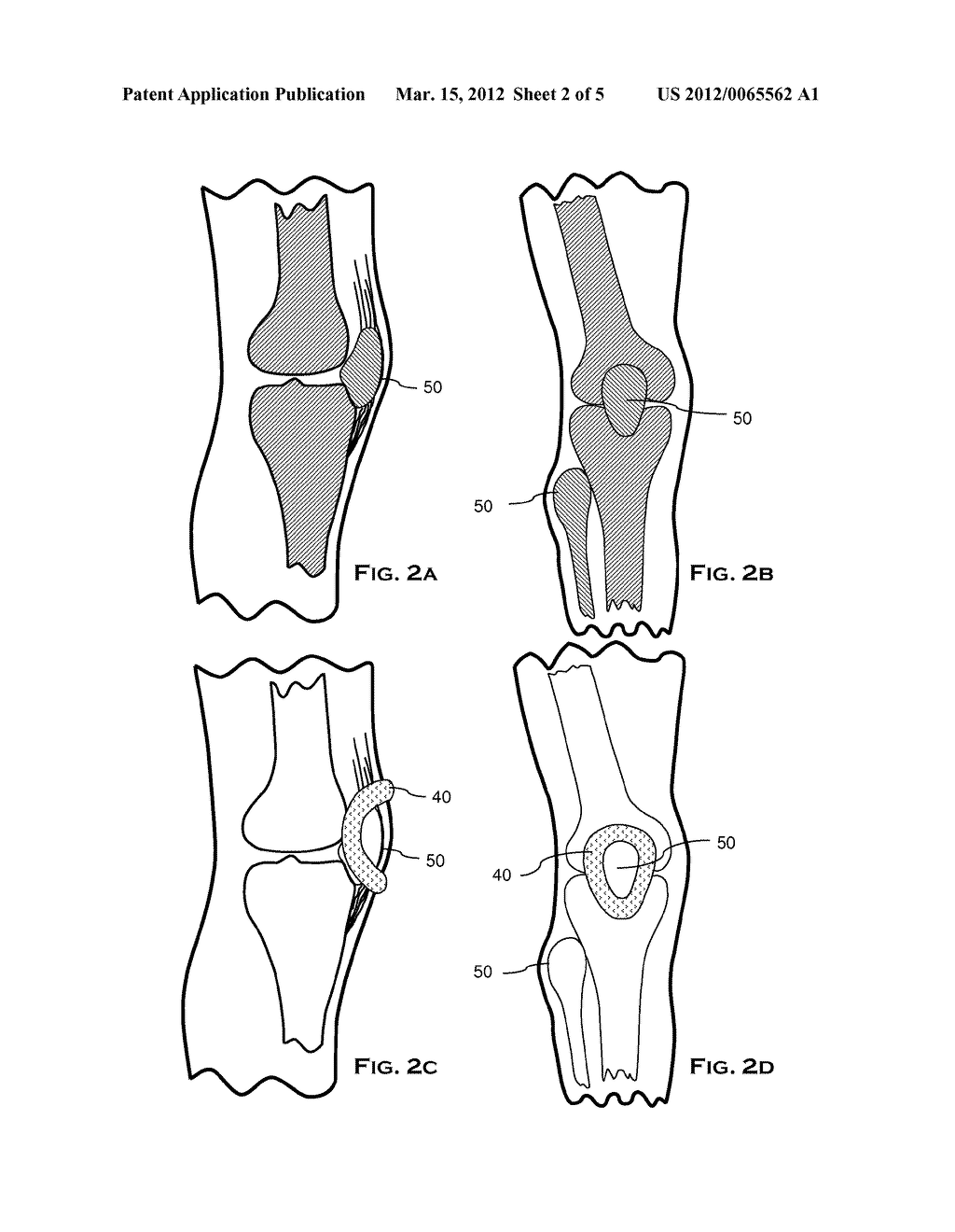 ORTHOTIC WITH LIMITED MIGRATION - diagram, schematic, and image 03