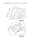 PATIENT-SPECIFIC KNEE ALIGNMENT GUIDE AND ASSOCIATED METHOD diagram and image