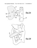 PATIENT-SPECIFIC KNEE ALIGNMENT GUIDE AND ASSOCIATED METHOD diagram and image