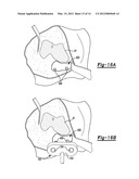 PATIENT-SPECIFIC KNEE ALIGNMENT GUIDE AND ASSOCIATED METHOD diagram and image