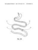 GASTRO-INTESTINLAL COMPRESSION DEVICE diagram and image