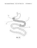 GASTRO-INTESTINLAL COMPRESSION DEVICE diagram and image