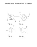 GASTRO-INTESTINLAL COMPRESSION DEVICE diagram and image