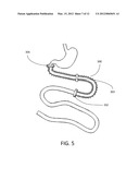 GASTRO-INTESTINLAL COMPRESSION DEVICE diagram and image