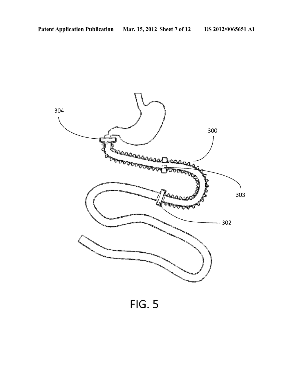 GASTRO-INTESTINLAL COMPRESSION DEVICE - diagram, schematic, and image 08