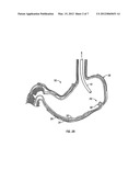 INTRA-GASTRIC FASTENING DEVICES diagram and image