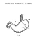 INTRA-GASTRIC FASTENING DEVICES diagram and image