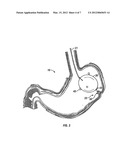 INTRA-GASTRIC FASTENING DEVICES diagram and image