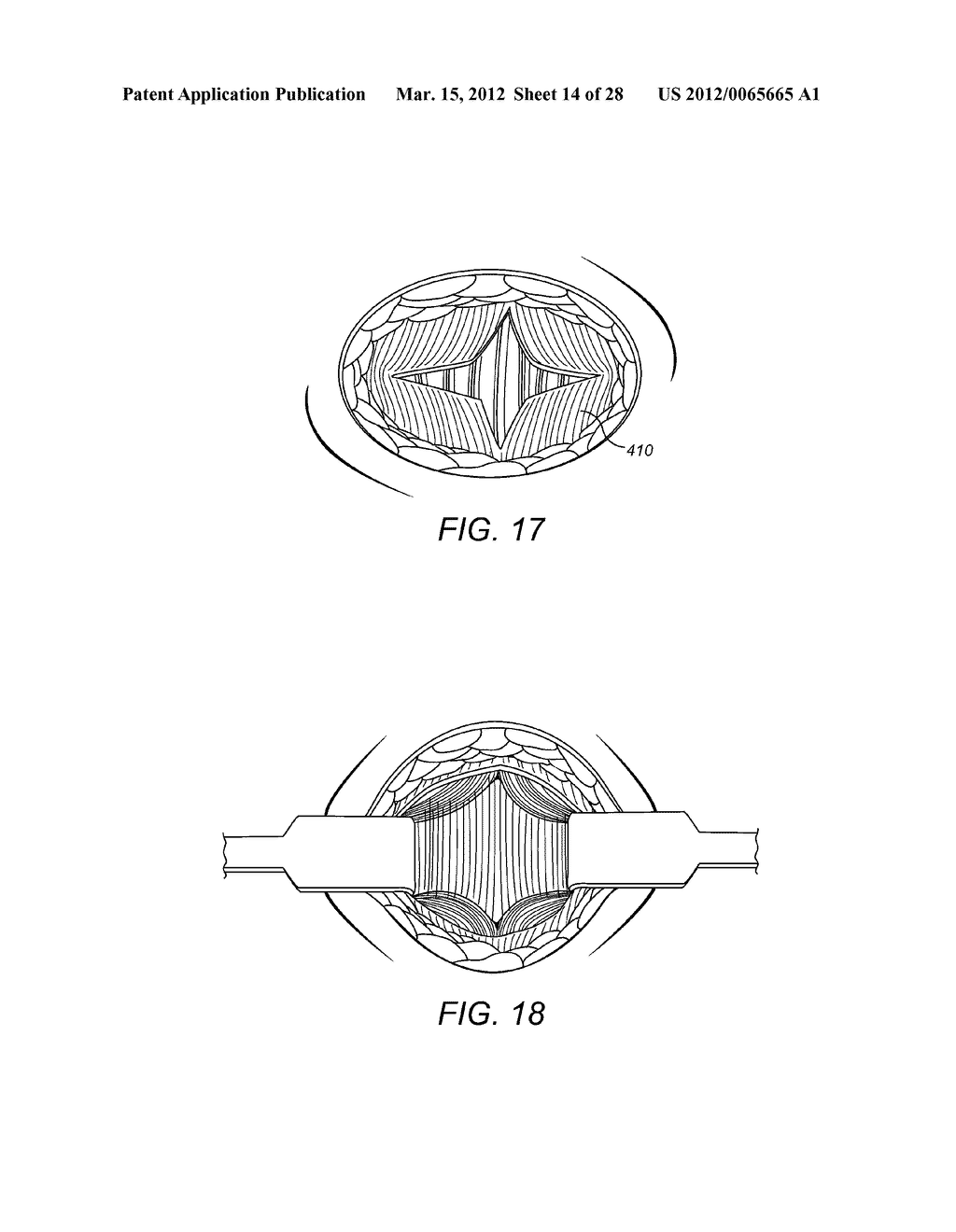 Forceps Comprising A Trocar Tip - diagram, schematic, and image 15