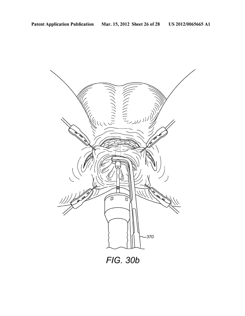 Forceps Comprising A Trocar Tip - diagram, schematic, and image 27