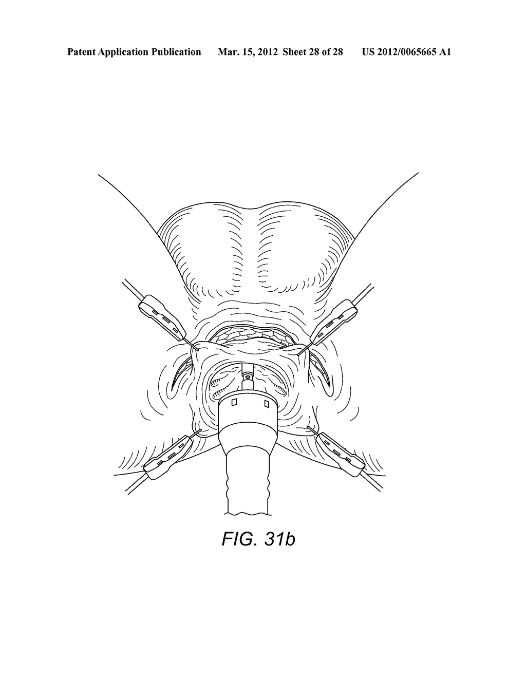 Forceps Comprising A Trocar Tip - diagram, schematic, and image 29