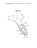 WIRED SUTURES diagram and image