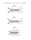 WIRED SUTURES diagram and image