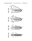 WIRED SUTURES diagram and image