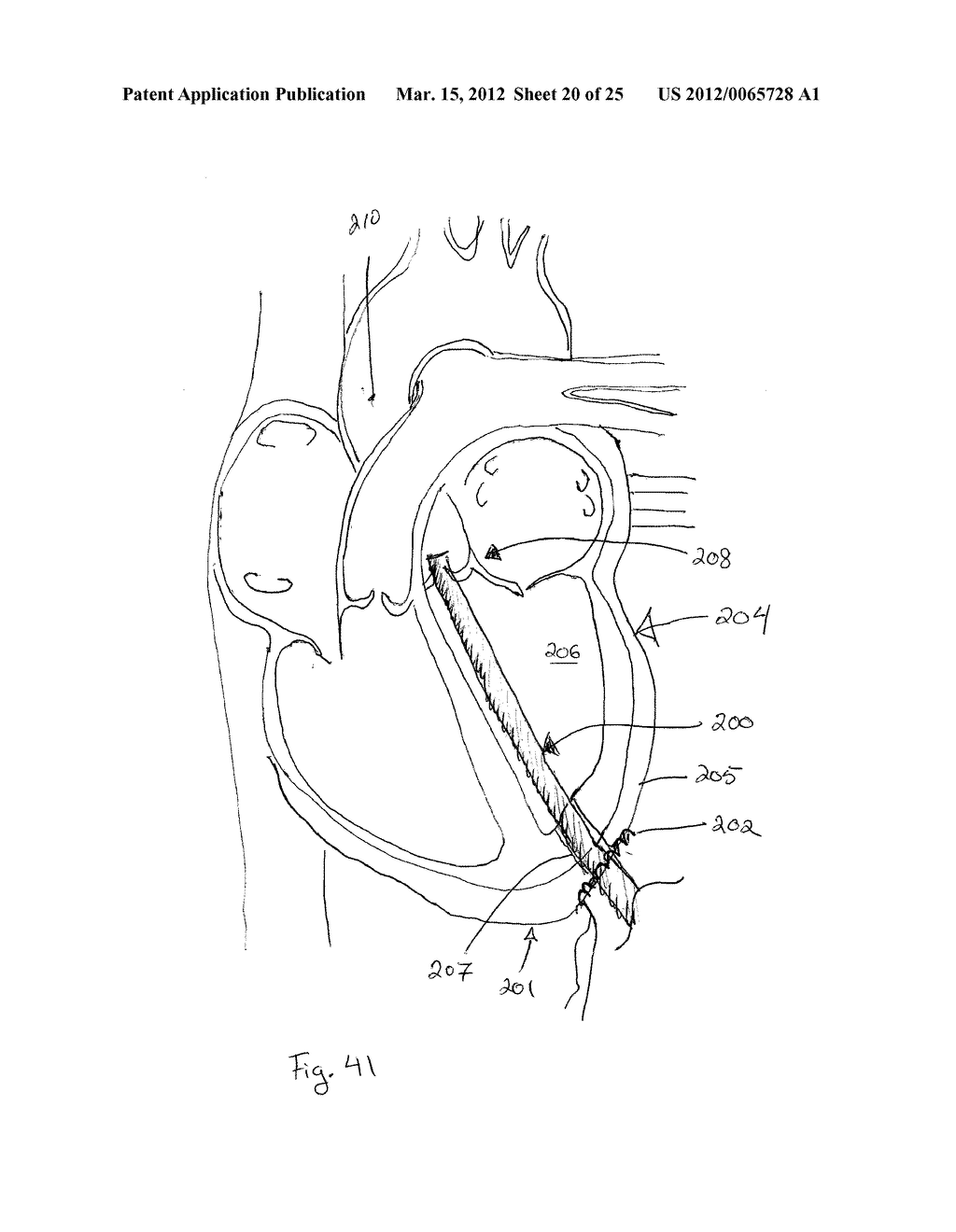 Stentless Support Structure - diagram, schematic, and image 21