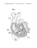 SYSTEMS AND METHODS FOR RAPIDLY DEPLOYING SURGICAL HEART VALVES diagram and image