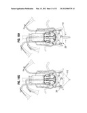 SYSTEMS AND METHODS FOR RAPIDLY DEPLOYING SURGICAL HEART VALVES diagram and image