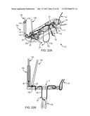 SYSTEMS AND METHODS FOR INTRA-OPERATIVE TENSION AND FIXATION OF ZIPKNOT     ACL FIXATION diagram and image