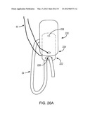 SYSTEMS AND METHODS FOR INTRA-OPERATIVE TENSION AND FIXATION OF ZIPKNOT     ACL FIXATION diagram and image