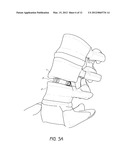 INTERVERTEBRAL PLATE SYSTEM diagram and image