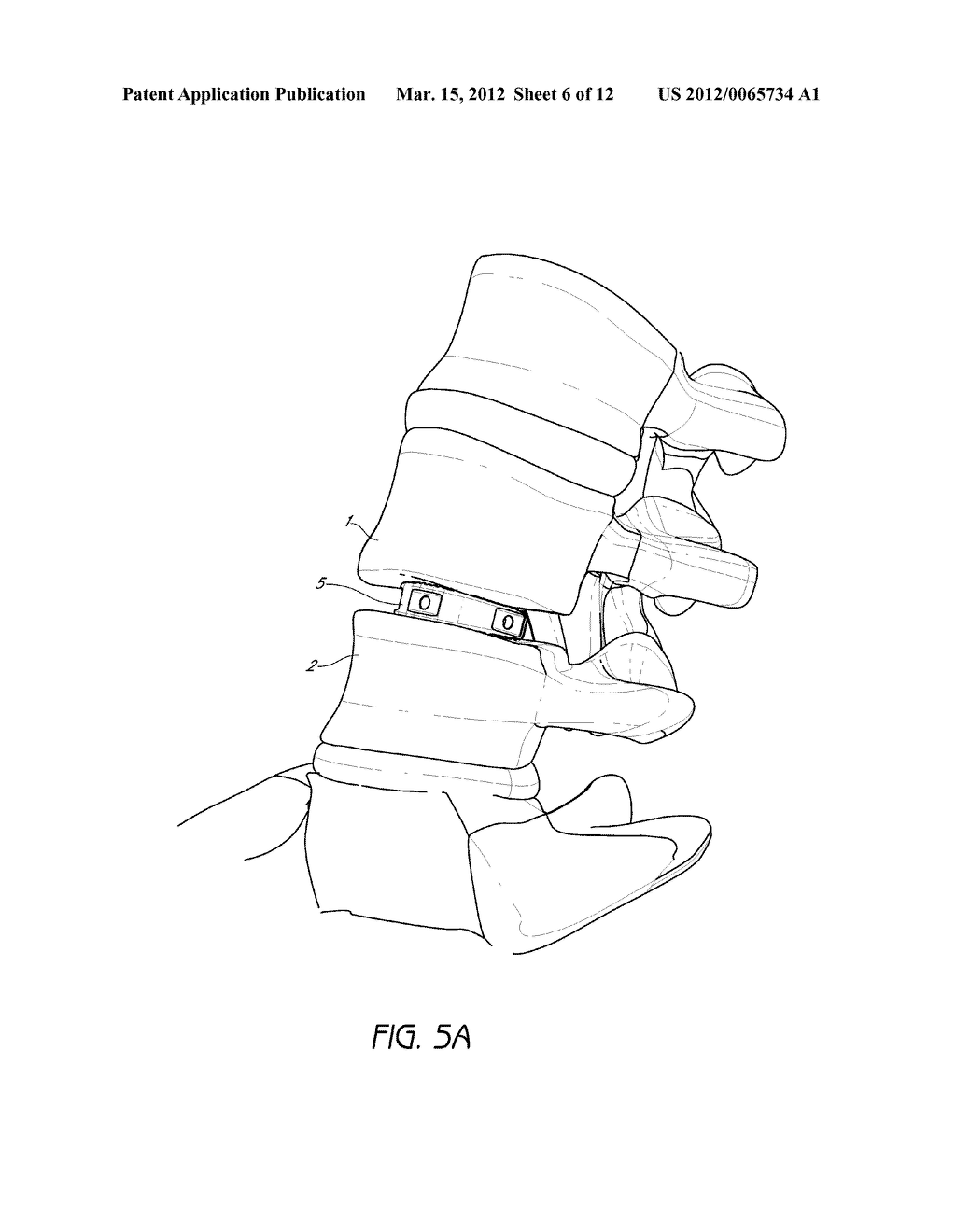 INTERVERTEBRAL PLATE SYSTEM - diagram, schematic, and image 07