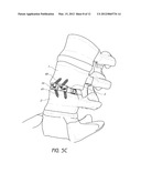 INTERVERTEBRAL PLATE SYSTEM diagram and image