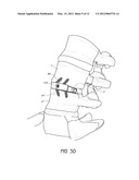 INTERVERTEBRAL PLATE SYSTEM diagram and image