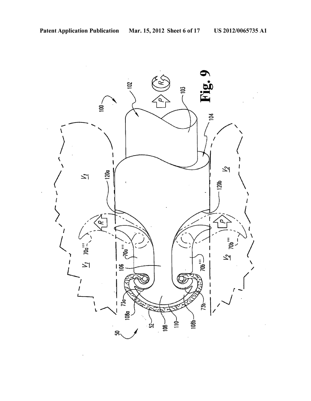 ANNULUS REPAIR SYSTEMS AND TECHNIQUES - diagram, schematic, and image 07