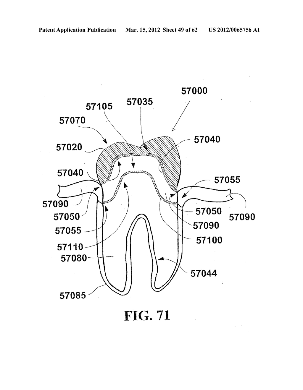 Methods of Designing and Manufacturing Customized Dental Prosthesis for     Periodontal or Osseointegration and Related Systems - diagram, schematic, and image 50