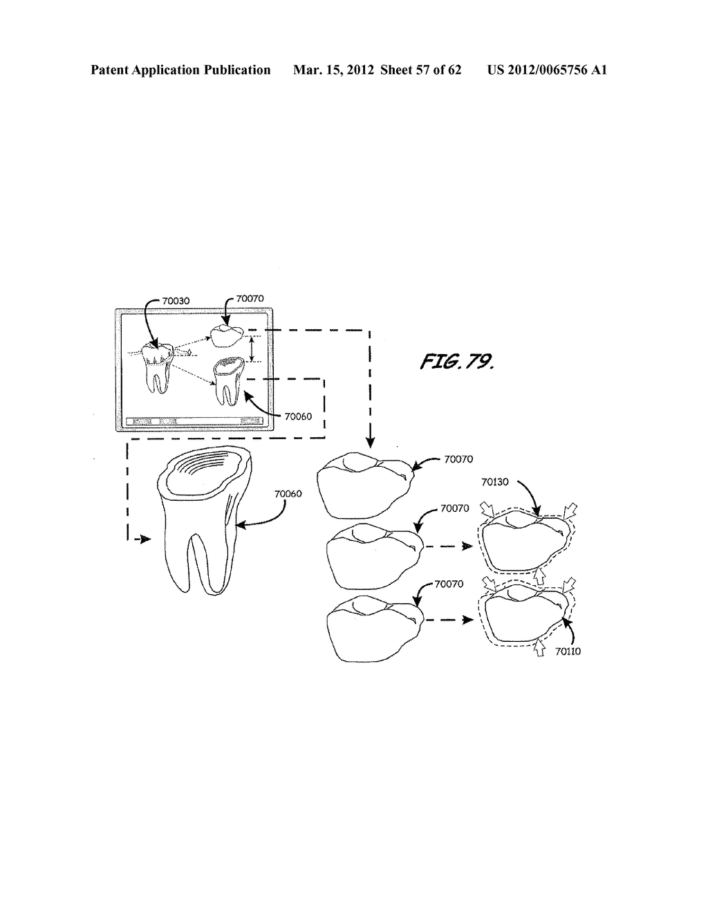 Methods of Designing and Manufacturing Customized Dental Prosthesis for     Periodontal or Osseointegration and Related Systems - diagram, schematic, and image 58