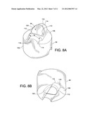 INTERNAL GASTRIC BANDER FOR OBESITY diagram and image