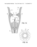 INTERNAL GASTRIC BANDER FOR OBESITY diagram and image