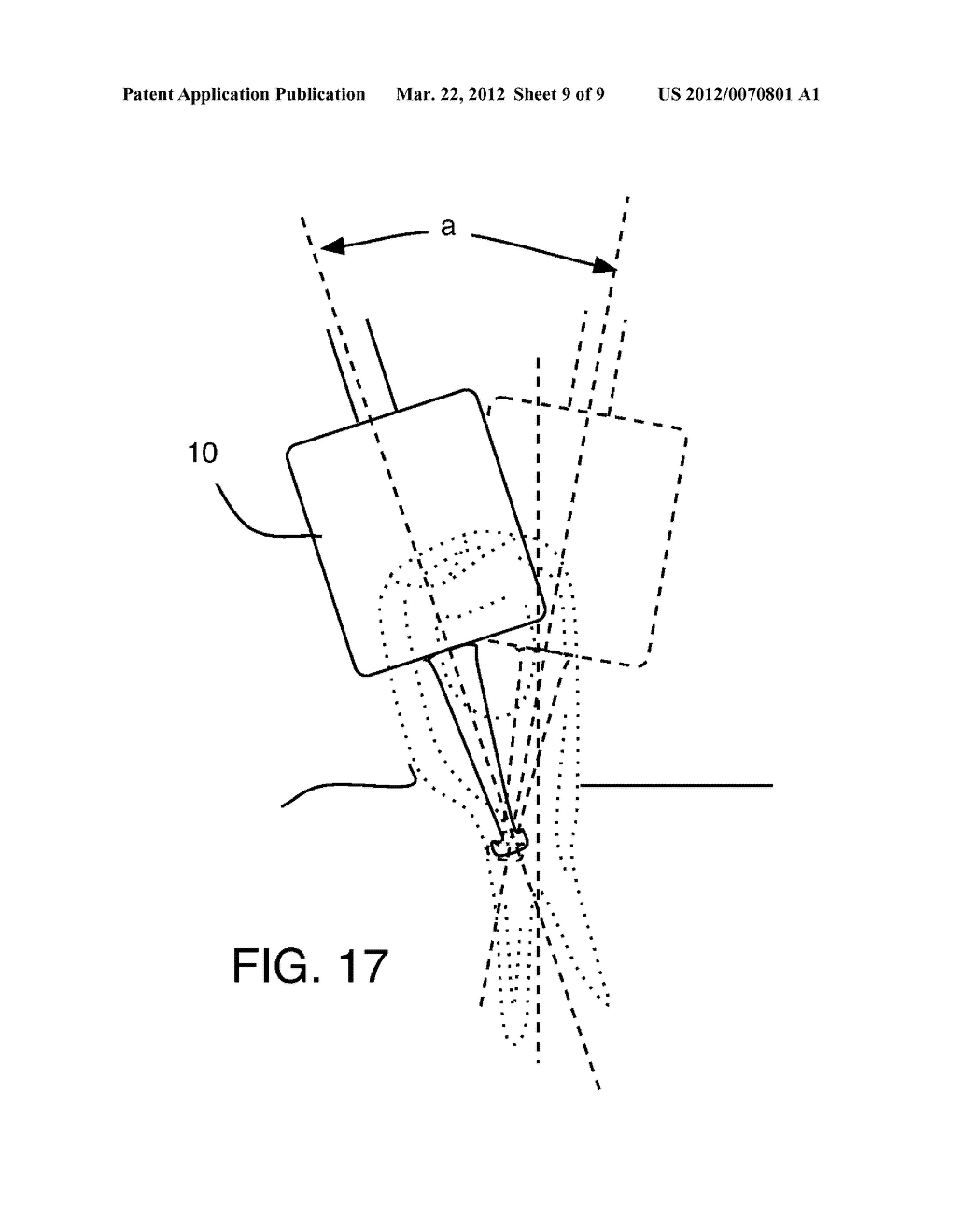 Dental implant locating device and method of use. - diagram, schematic, and image 10