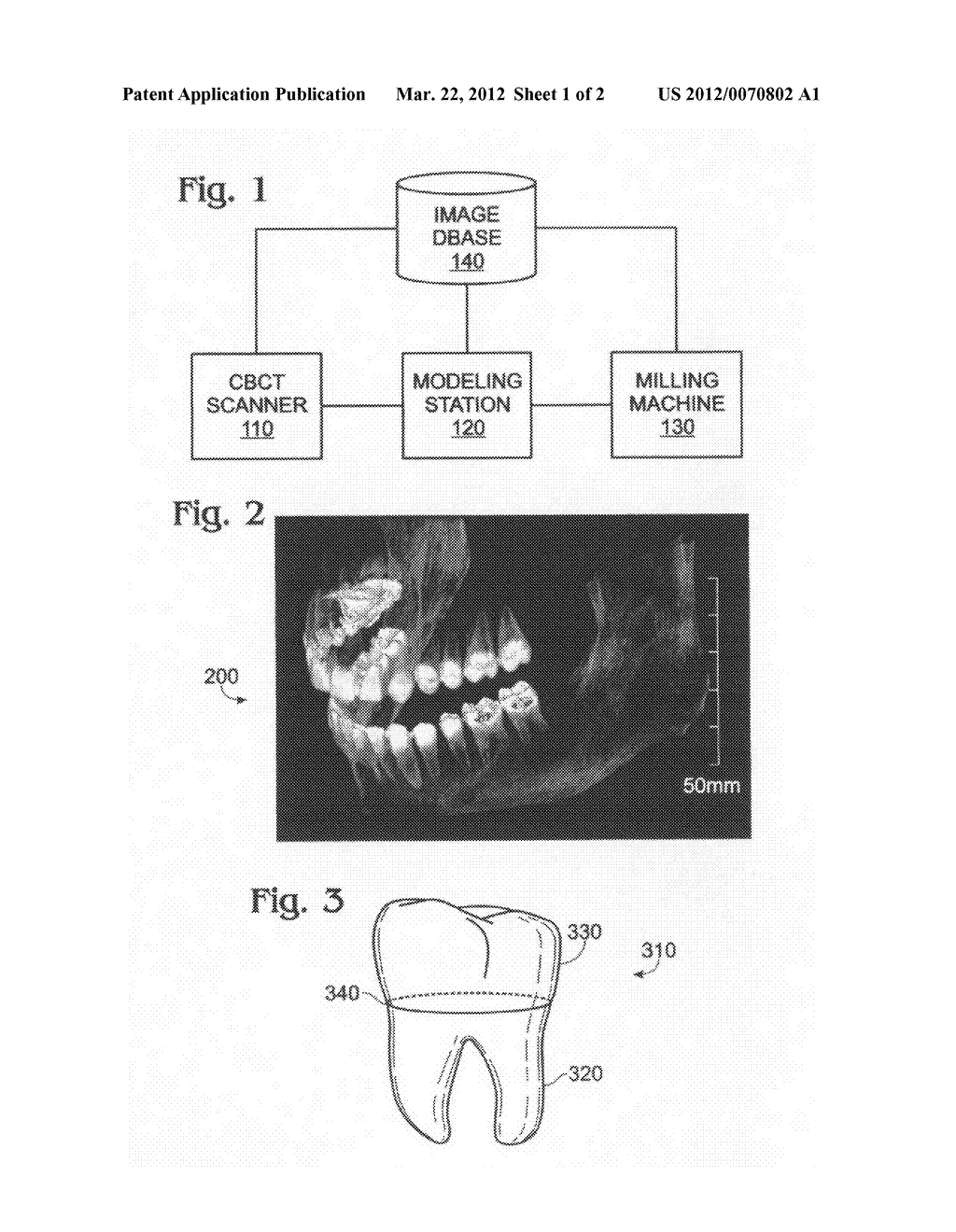 Dental implant fabrication and insertion methods and personalized dental     implant for use therein - diagram, schematic, and image 02