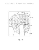 METHOD FOR PROVIDING SURGICAL ACCESS diagram and image