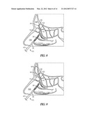 METHOD AND ARTICLES FOR TREATING THE SINUS SYSTEM diagram and image