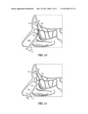 METHOD AND ARTICLES FOR TREATING THE SINUS SYSTEM diagram and image