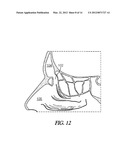 METHOD AND ARTICLES FOR TREATING THE SINUS SYSTEM diagram and image