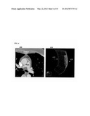 Method and System for Automatic Native and Bypass Coronary Ostia Detection     in Cardiac Computed Tomography Volumes diagram and image