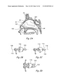 Devices, Systems and Methods for Treating Disorders of the Ear, Nose and     Throat diagram and image