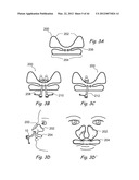 Devices, Systems and Methods for Treating Disorders of the Ear, Nose and     Throat diagram and image