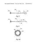 Devices, Systems and Methods for Treating Disorders of the Ear, Nose and     Throat diagram and image