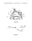 Devices, Systems and Methods for Treating Disorders of the Ear, Nose and     Throat diagram and image