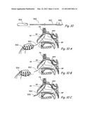 Devices, Systems and Methods for Treating Disorders of the Ear, Nose and     Throat diagram and image