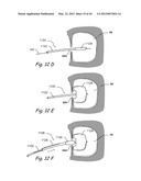 Devices, Systems and Methods for Treating Disorders of the Ear, Nose and     Throat diagram and image